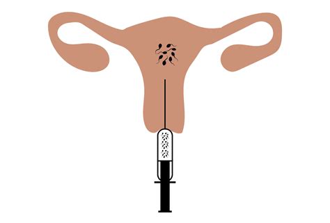 Treatment Option Intrauterine Insemination Iui — Arbor Fertility