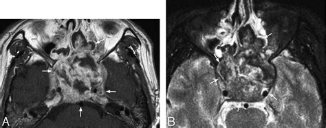 Nasal Polyp Mri