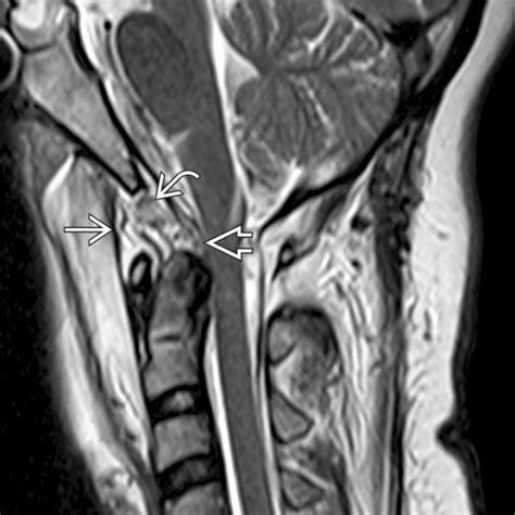 Atlantooccipital Dislocation Clinical Tree