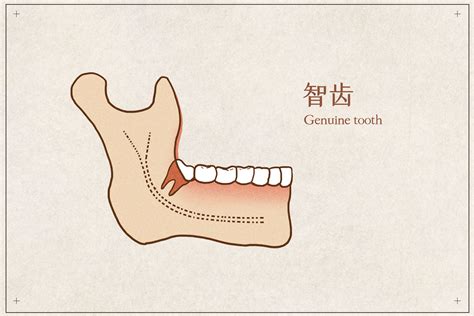 什么是智齿？怎么知道自己长智齿了？何时需要拔掉智齿？（智齿系列一） 纽约 牙科诊所 皇后区 法拉盛 洗牙 人工 植牙 牙医 牙科 诊所