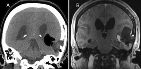 Intracranial Dermoid Cyst Rupture