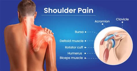 Shoulder Bursitis Also Known As Subacromial Bursitis Is A Medical