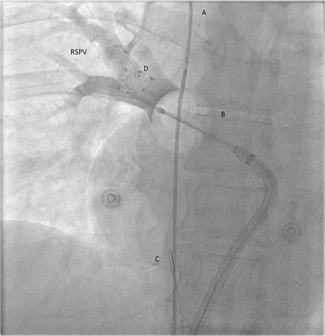 Cryoballoon Ablation Anterior Posterior View The Cb Is Positioned At Download Scientific