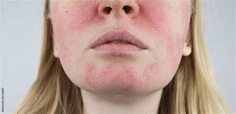 Rosacea Face The Girl Suffers From Redness On Her Cheeks Couperosis Of The Skin Redness And