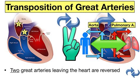 Congenital Heart Diseases Cyanotic Defects Made Easy Ezmed