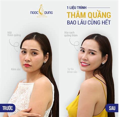 Top 3 Thẩm Mỹ Viện Trị Thâm Quầng Mắt Nổi Tiếng Nhất Hiện Nay Thẩm Mỹ