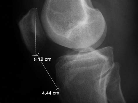 The Evaluation Of Patellar Height A Simple Method Jbjs