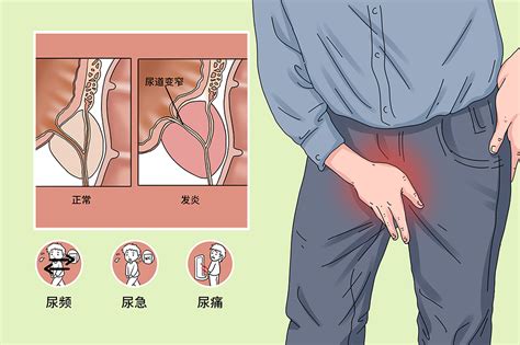 急性前列腺炎 有来医生