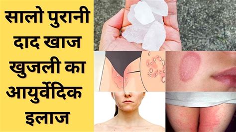 दद खज खजल क 2 दन म जड स खतम करग Fungal Infection Home