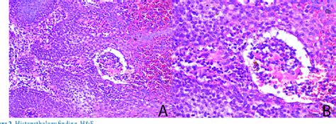 Figure From Pemphigus Vegetans Hallopeau With Nail Changes And No