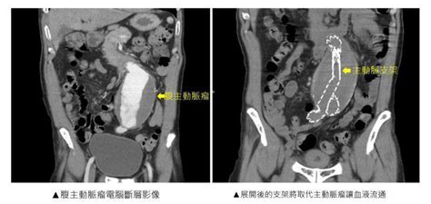 腹部有心跳？超大主動脈瘤 就像無聲無息未爆彈 醫藥百科 健康 世界新聞網