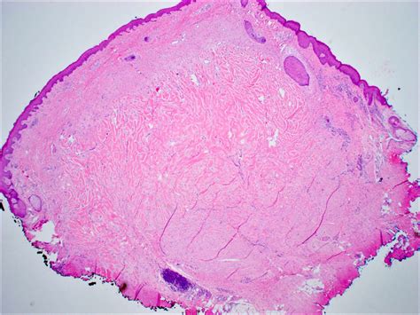 Keloid Histology