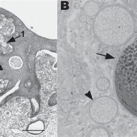 A Section Of Nasal Mucosa Showing Multifocal Hyperplasia Juvenile