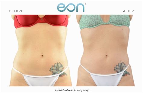 Eon Body Laser Contouring Fda Cleared For Reducing Unwanted Belly Fat