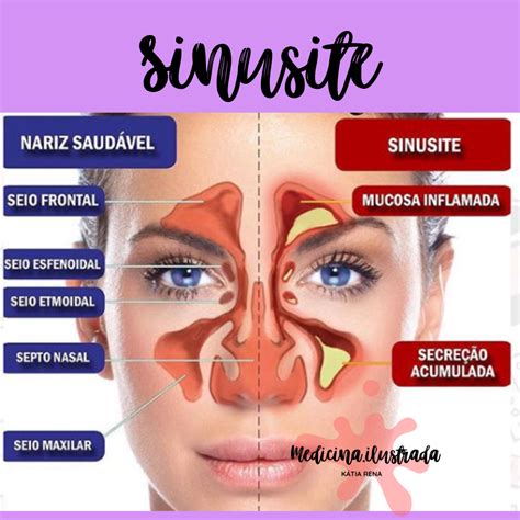 Quanto Tempo Dura Sinusite