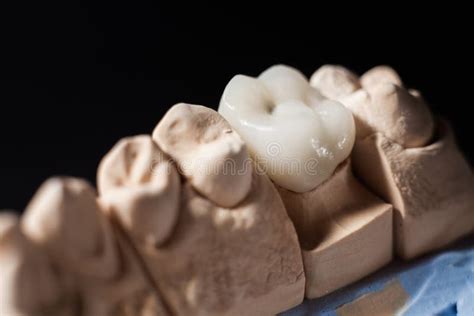 Mold Of Teeth Gypsum Model Plaster Of Teeth Dentistry And