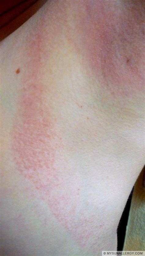 Polymorphous Light Eruption(PMLE) pictures and sun allergy rash images