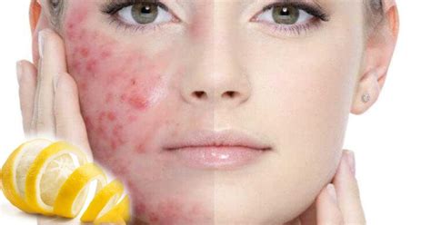 Лікування розацеа лазером Derm.com [ 20 років досвіду ]