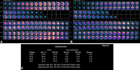 Anomalous Origin Of The Left Coronary Artery In Patient With Reduction