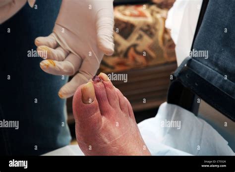 Necrosis Foot Hi Res Stock Photography And Images Alamy