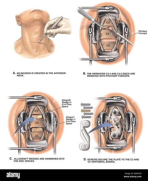 Cervical Spinal Fusion Surgery