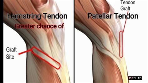 ACL Reconstruction Graft Options YouTube