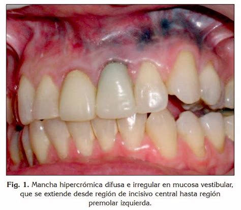 PDF Tatuaje por Amalgama un peculiar caso clínico