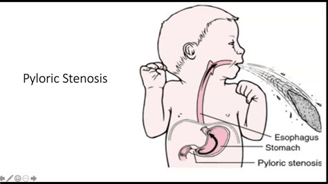 Hypertrophic Pyloric Stenosis Youtube