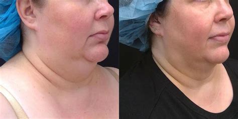 Kybella Before And Afters Franklin Skin And Laser