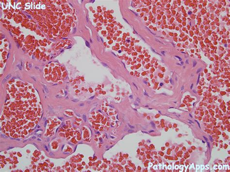 Hemangioma Histology