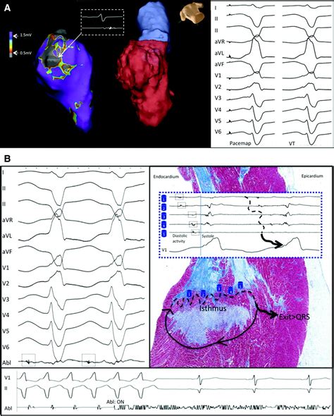 Catheter Ablation Of Ventricular Tachycardia Circulation