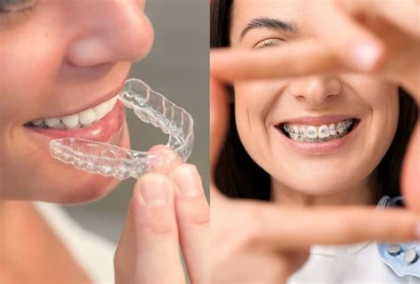 Transforma tu sonrisa con ortodoncia Tipos de tratamientos y cuál elegir