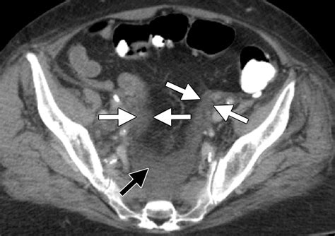 Retroperitoneal Fasciitis Spectrum Of Ct Findings In The Abdomen And Pelvis Radiographics