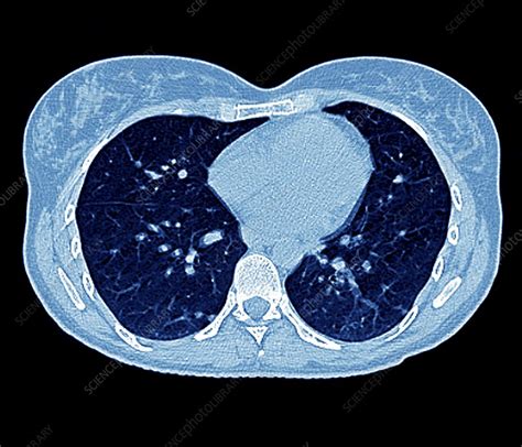 Secondary Lung Cancer CT Scan Stock Image M134 0886 Science