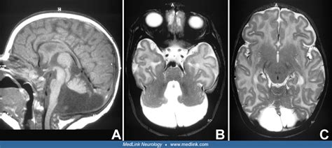 Dandy Walker Syndrome Mri