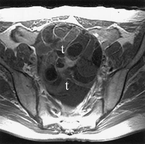 Imaging Evaluation Of Ovarian Masses Radiographics