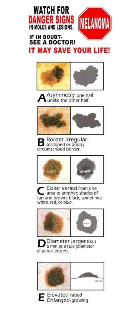 Moles And Birthmarks Dermatology Care Of Charlotte