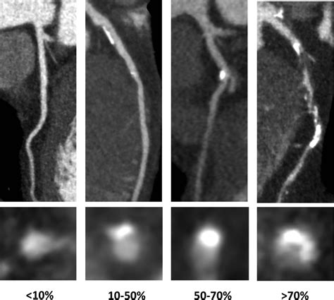 Observer Variability In The Assessment Of CT Coronary Angiography And