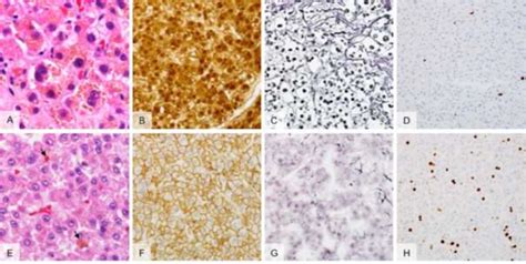 Figure From Giant Hepatocellular Carcinoma With Bone Metastasis In A