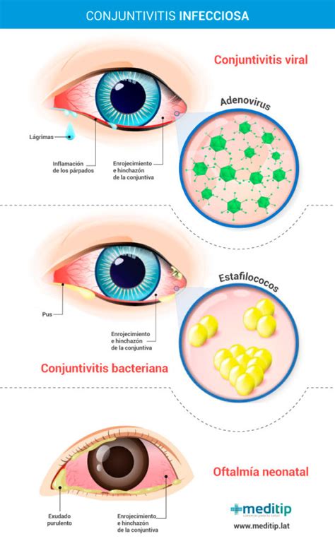 Tratamiento De La Conjuntivitis Identifica Los S Ntomas Que Requieren