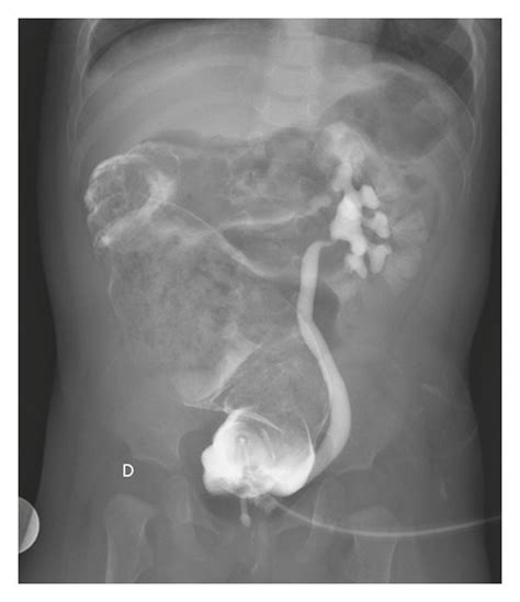 Grade 3 Unilateral Vesicoureteral Reflux Vur With A Thin Tract