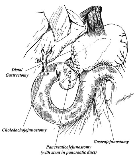 Reconstruction Sequence In A Classic Whipple Antrectomy Or Download Scientific Diagram