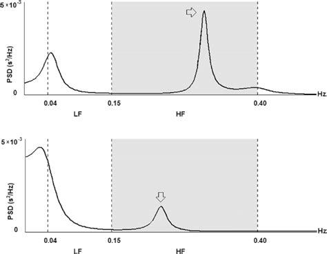 Hrv Frequency Domain Analysis In Two Patients From The Dlr And Dlr −