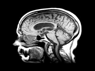 Lissencephaly – Symptoms, Causes, Treatment, Preventions, Diagnosis