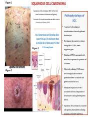 Understanding Squamous Cell Carcinoma Causes Symptoms And Course Hero