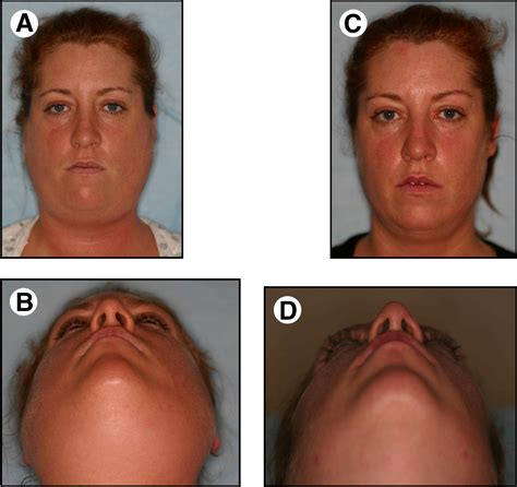 Rapidly Progressing Bilateral Submandibular Sialadenitis And