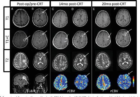 Figure From Evaluation Of Pseudoprogression In Patients With