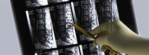 Tetraplegia - forms, therapy, etc. | STIWELL