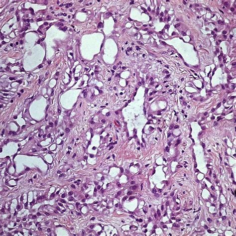 Pdf Tumor Adenomatoide Paratesticular A Propósito De Um Caso Clínico