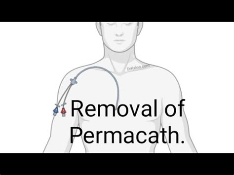 Removal of Permacath. - YouTube